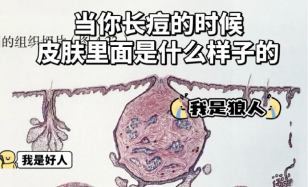 皮肤爆痘留印又留坑的真相